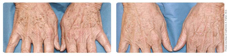 brown spots on hands before after