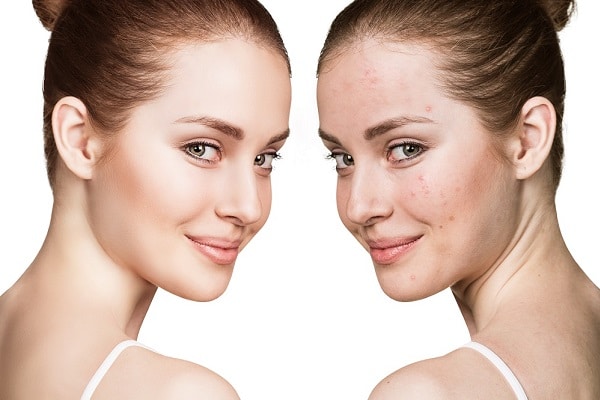 Acne pimples skin care treatments