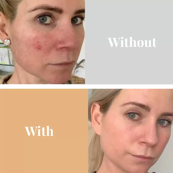 Omnilux Red light Face Mask before after