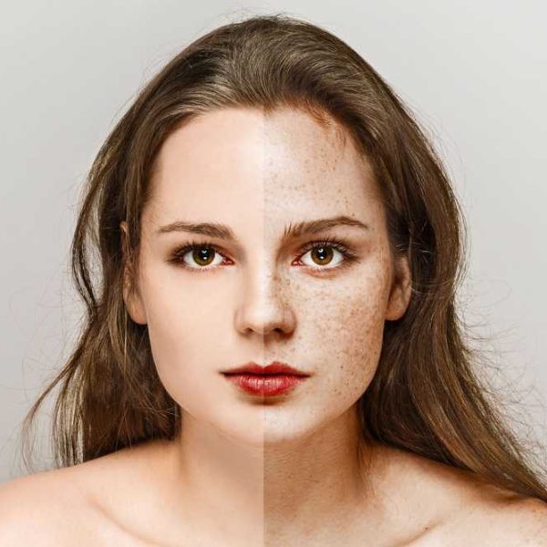 Brown spots pigmentation treatment Illawarra