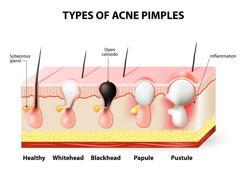 types of acne pimples illustration